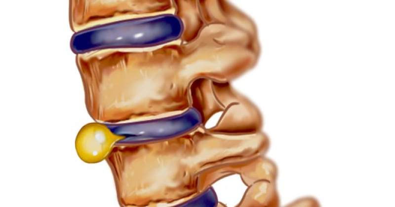 Hernia De Disc Cauze Si Simptome