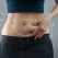 Abdominoplastia după chirurgia bariatrică